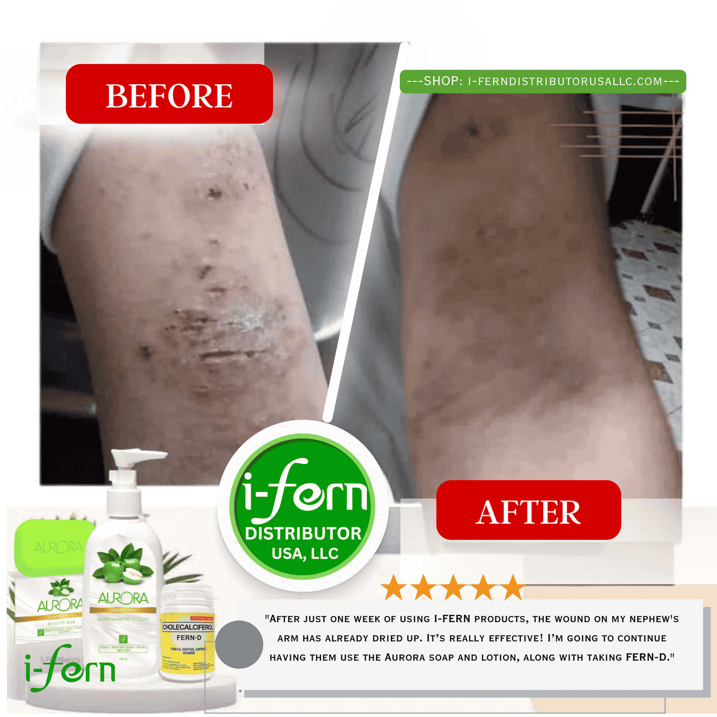 Before and after comparison of skin treatment with i-fern products, I-Fern AURORA Soap and AURORA Lotion and Fern-D sold online on i-ferndistiributorusallc.com