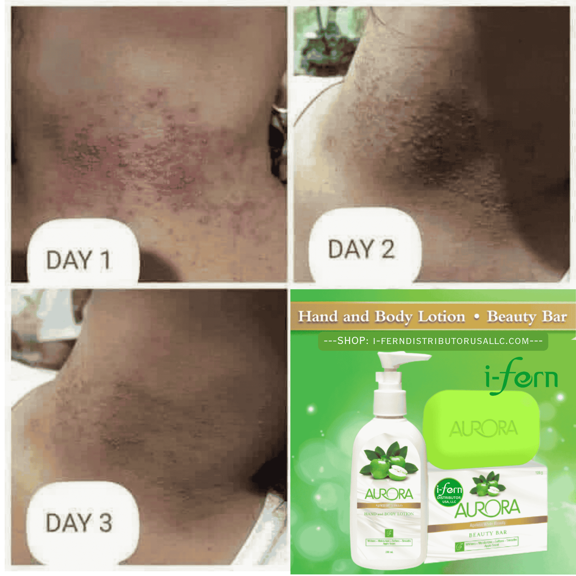Before-and-after comparison of skin treatment on Day 1, Day 2, and Day 3 with i-Fern AURORA Soap and AURORA Body Lotion products displayed sold online on i-ferndistiributorusallc.com