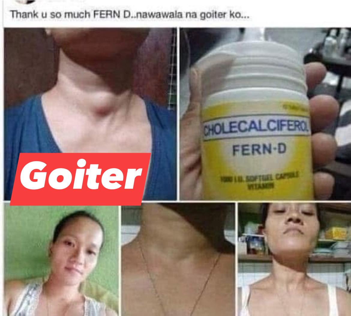 before picture of women with goiter and yellow bottle of fern-d on hand and after picture of woman with smaller size goiter.