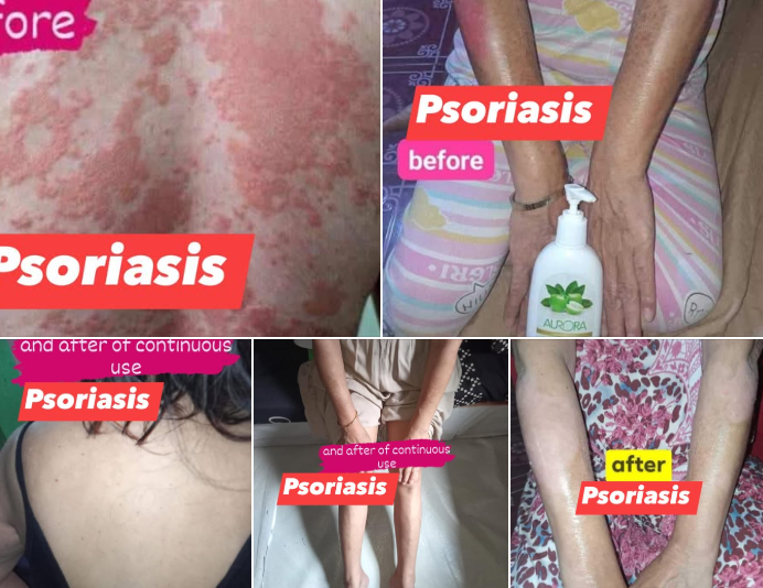 lady with psoriasis on her back and hands and showing after picture cleared her skins she holding aurora lotion